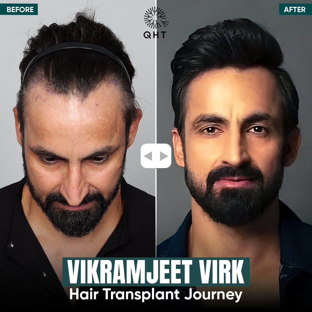 Understanding Hair Transplant Cost in India